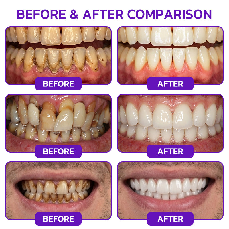 🇺🇸❤️🦷Evolvion® Bee Venom Gingivitis & Periodontitis Treatment Toothpaste🎁