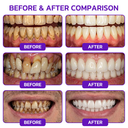 🇺🇸❤️🦷Evolvion® Bee Venom Gingivitis & Periodontitis Treatment Toothpaste🎁