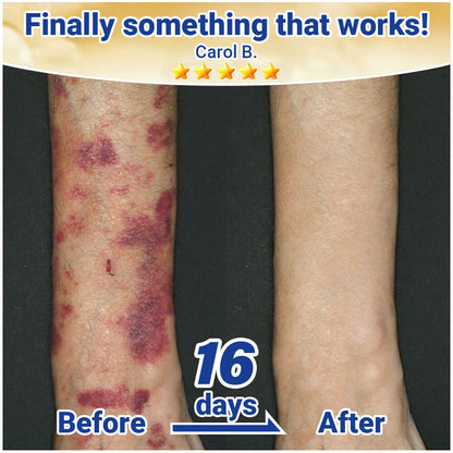 💥 2026 Best-Selling Skin Care | Rolimey® Bruise Care Cream | Advanced Care for Fragile, Aging & Bruise-Prone Skin