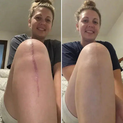 🎁 30% OFF Rolimey® Silicone Scar Gel – Advanced Scar Care 🛡️