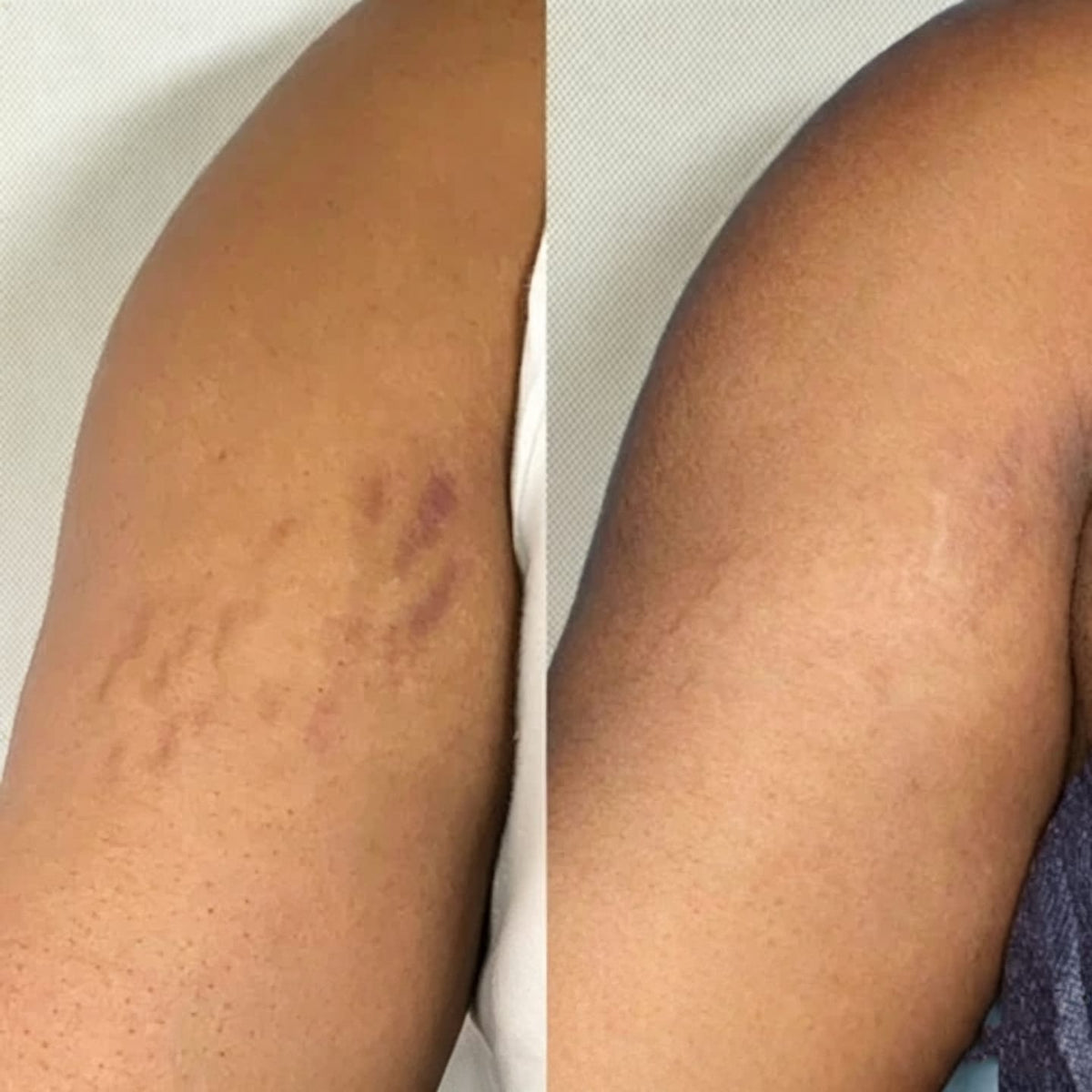 🎁 30% OFF Rolimey® Silicone Scar Gel – Advanced Scar Care 🛡️