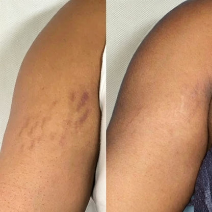 🎁 30% OFF Rolimey® Silicone Scar Gel – Advanced Scar Care 🛡️