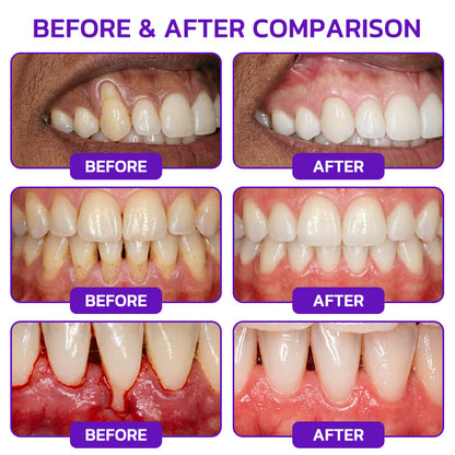 🇺🇸❤️🦷Evolvion® Bee Venom Gingivitis & Periodontitis Treatment Toothpaste🎁