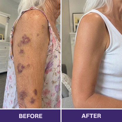 ✨👩‍⚕️Rolimey® BruiseRepair & Skin-Strengthening Cream-Advanced daily care forbruise-prone skin