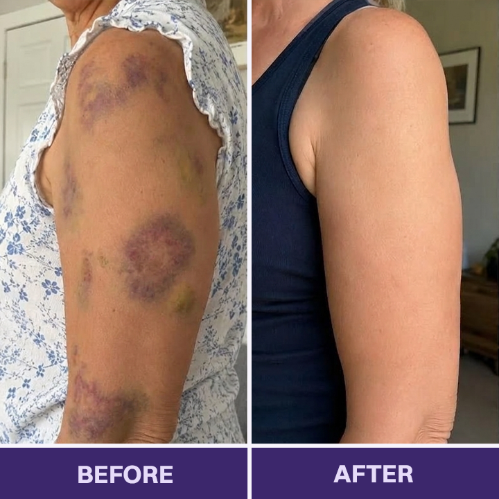 ✨👩‍⚕️Rolimey® BruiseRepair & Skin-Strengthening Cream-Advanced daily care forbruise-prone skin