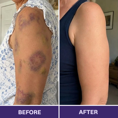 ✨👩‍⚕️Rolimey® BruiseRepair & Skin-Strengthening Cream-Advanced daily care forbruise-prone skin