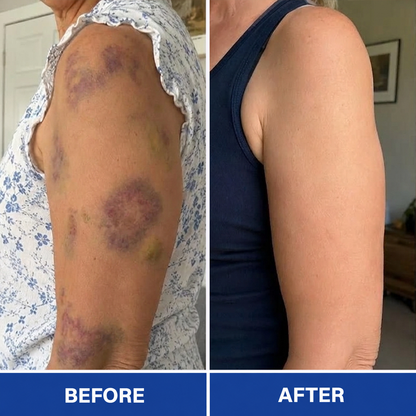 🎁30%off Rolimey® BruiseRepair & Skin-Strengthening Cream🎁