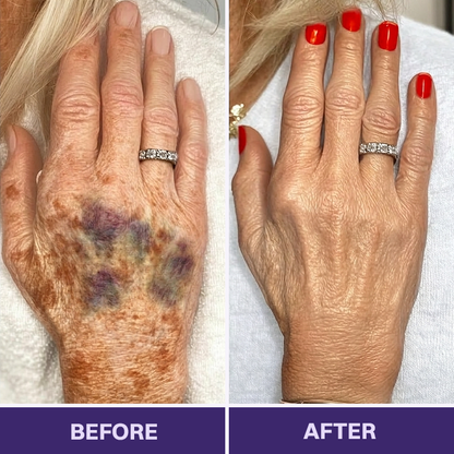 ✨👩‍⚕️Rolimey® BruiseRepair & Skin-Strengthening Cream-Advanced daily care forbruise-prone skin