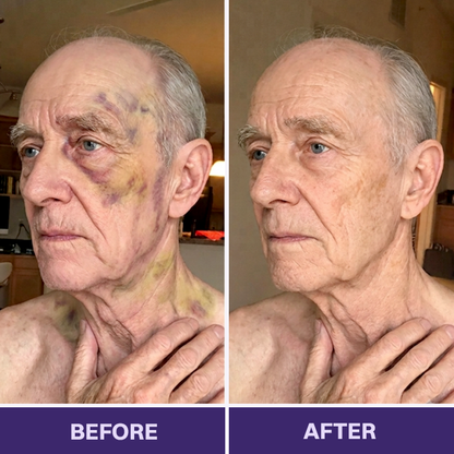 ✨👩‍⚕️Rolimey® BruiseRepair & Skin-Strengthening Cream-Advanced daily care forbruise-prone skin