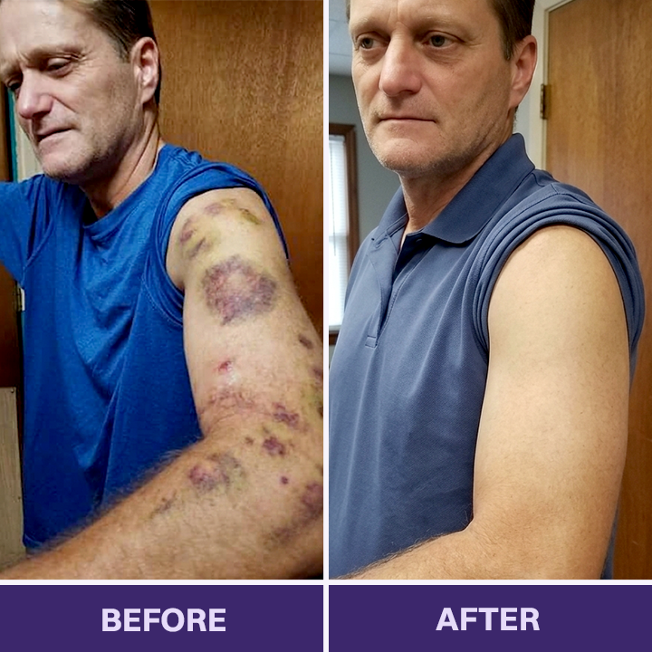 ✨👩‍⚕️Rolimey® BruiseRepair & Skin-Strengthening Cream-Advanced daily care forbruise-prone skin