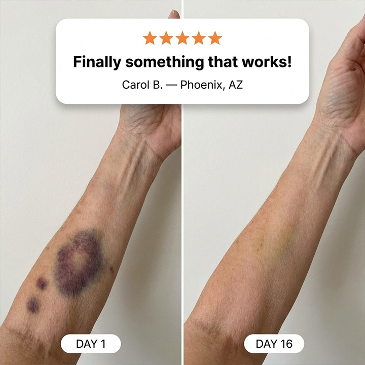✨👩‍⚕️Rolimey® BruiseRepair & Skin-Strengthening Cream-Advanced daily care forbruise-prone skin