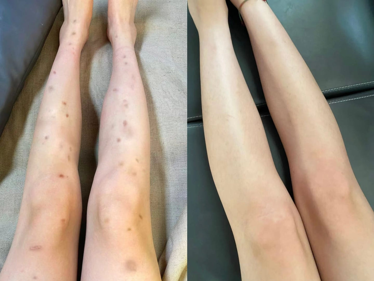 🎁 30% OFF Rolimey® Silicone Scar Gel – Advanced Scar Care 🛡️